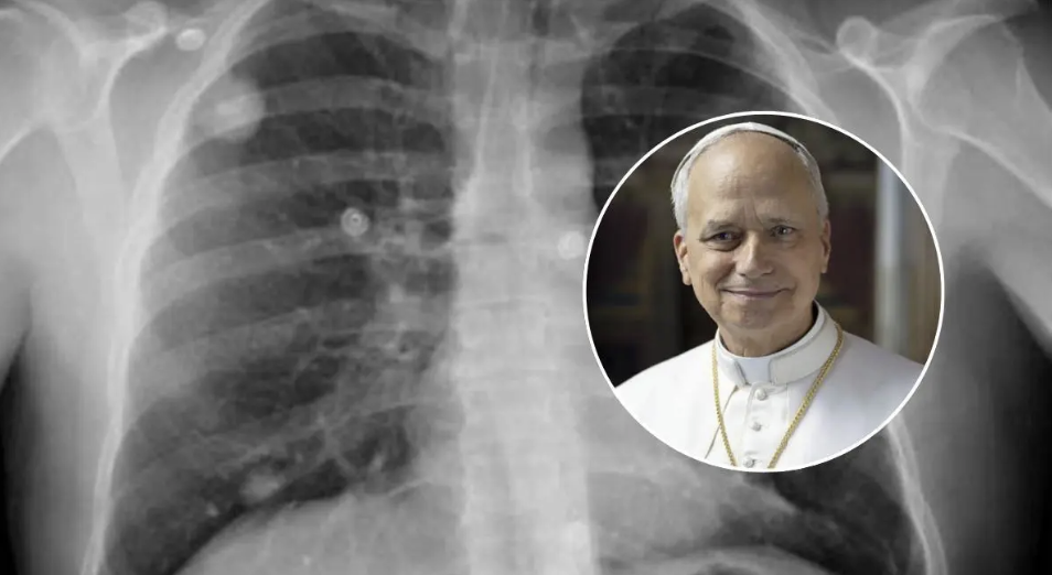 ¿Qué es un adenocarcinoma? El tipo de cáncer de pulmón diagnosticado al papa León XIV