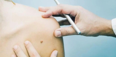 Vacuna contra cáncer de piel podría estar disponible en 2025